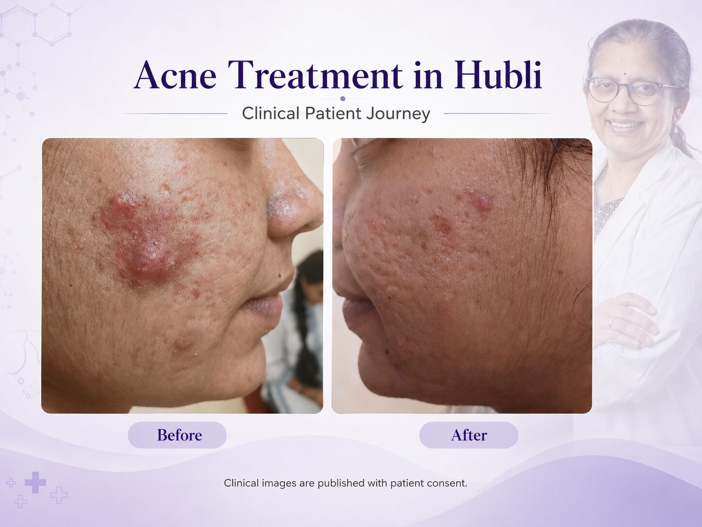 Acne Treatment in Hubli by Dermatologist Dr Savitha Raichur Through a Real Patient Journey